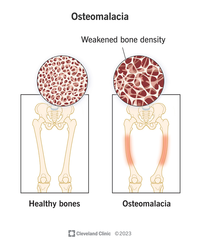 Calcium Deficiency Bones: Symptoms, Causes & Treatment