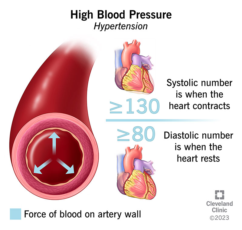 What Really Causes High Blood Pressure & How to Tackle