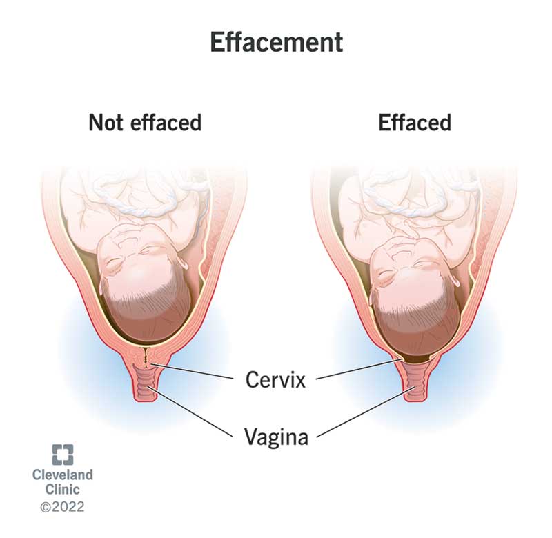 Cervical Softening: Quick Answers & Safe Support