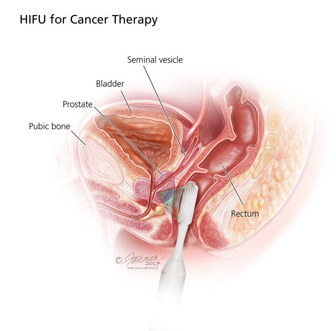 Early Prostate Cancer: Essential Facts You Need Now