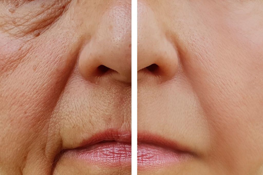 Face Wrinkle Treatment: Fast, Safe Ways to Smooth Skin