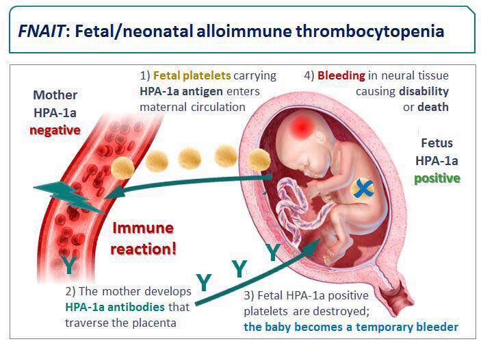 Gestational Thrombocytopenia: A Guide for Moms