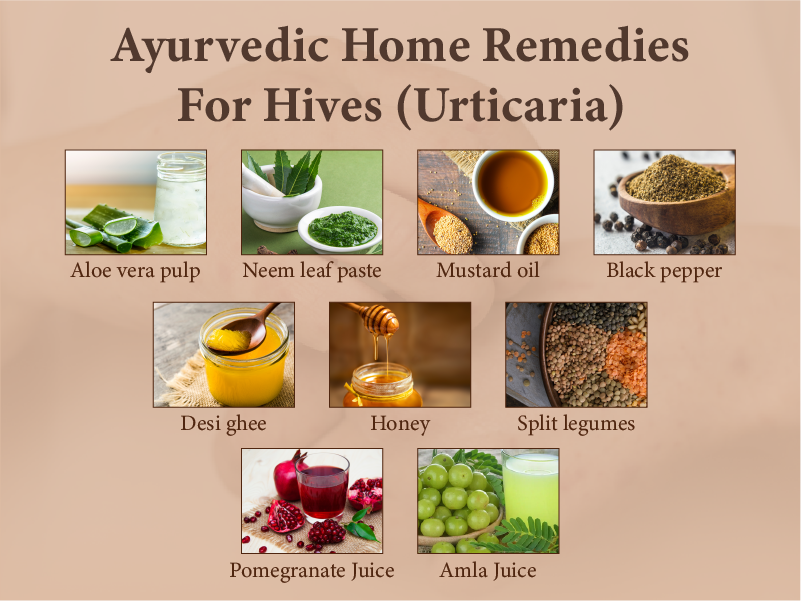 Fast, Safe Hives Home Treatment You Can Start Now