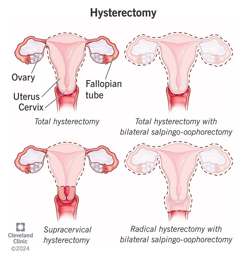 Hysterectomy Types: Quick Guide to What, Why & How