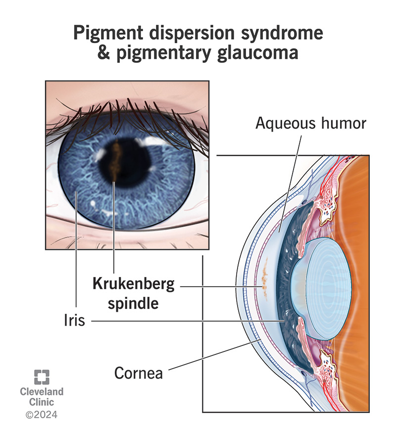 Iris Pigment Dispersion: Quick Facts & Why It Matters