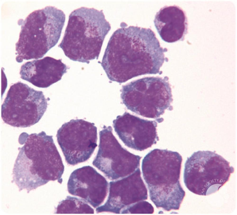 Leukemia in CSF: Symptoms, Treatment & Survival Outlook