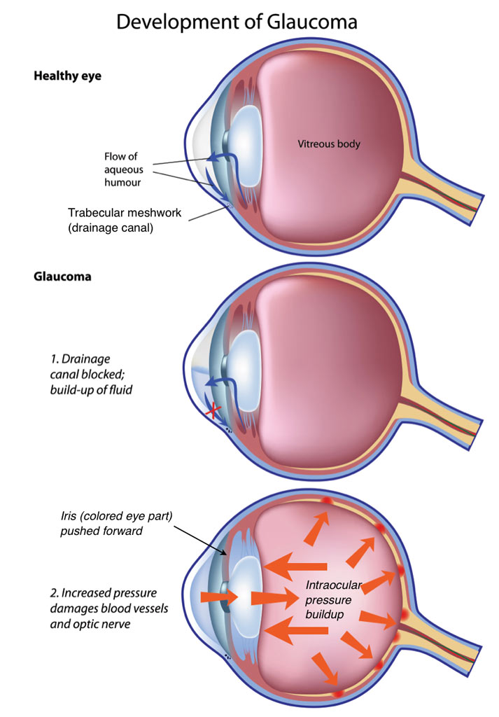 Low Pressure Glaucoma – What You Need to Know Now