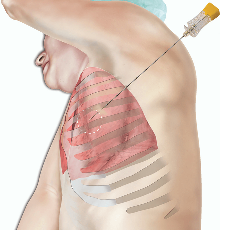 Lung Biopsy Preparation: Your Complete Safe Guide