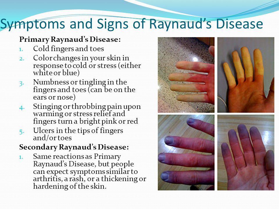 Lupus Raynaud Cause: What Triggers This Condition?