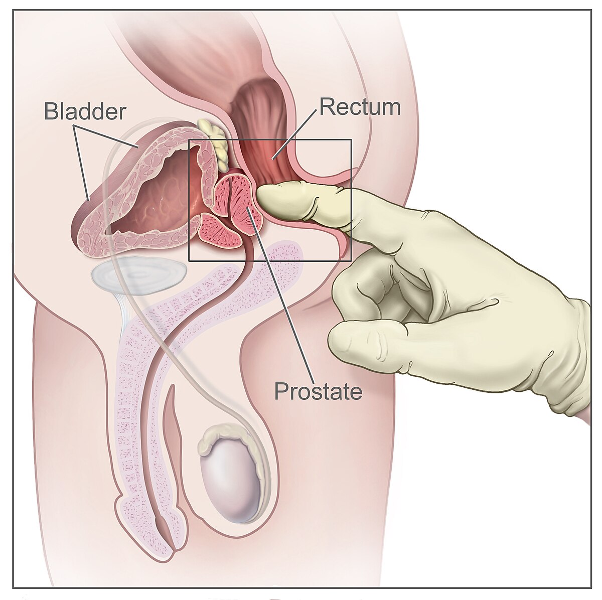 Milk and Prostate – Benefits, Risks, and Simple Facts