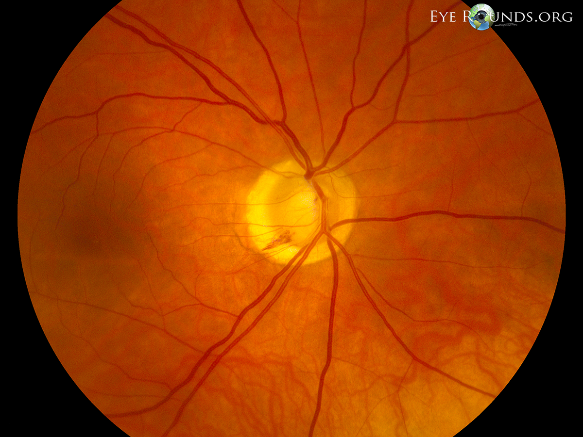 Normal Tension Glaucoma: Causes, Symptoms & Treatment