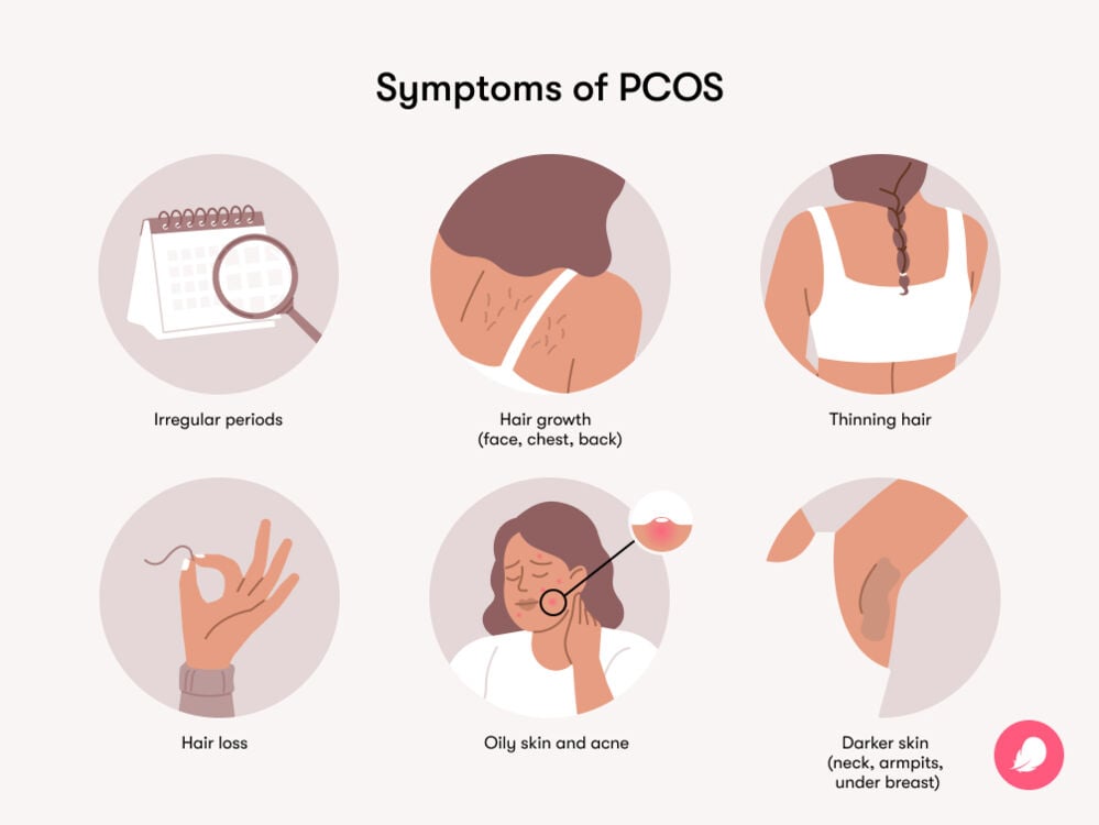 PCOS After Pill: Causes, Symptoms & Treatment