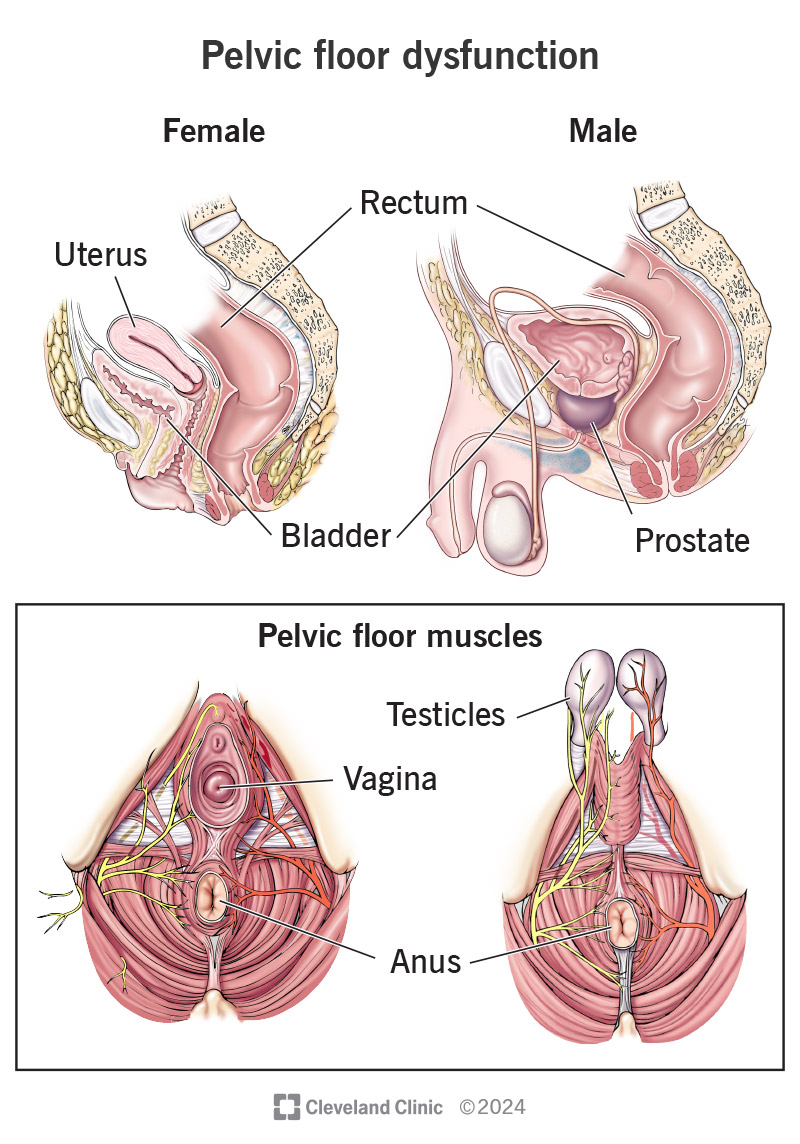 Pelvic Floor Constipation: Causes, Relief & Tips