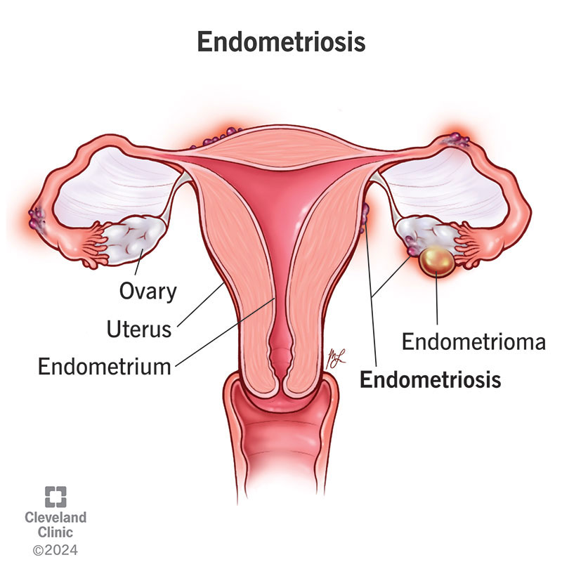 Pelvic Pain & Endometriosis – Quick Answers You Need