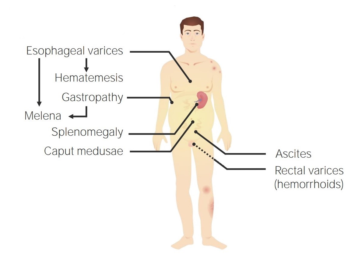 Portal Hypertension Symptoms: Signs & What They Mean