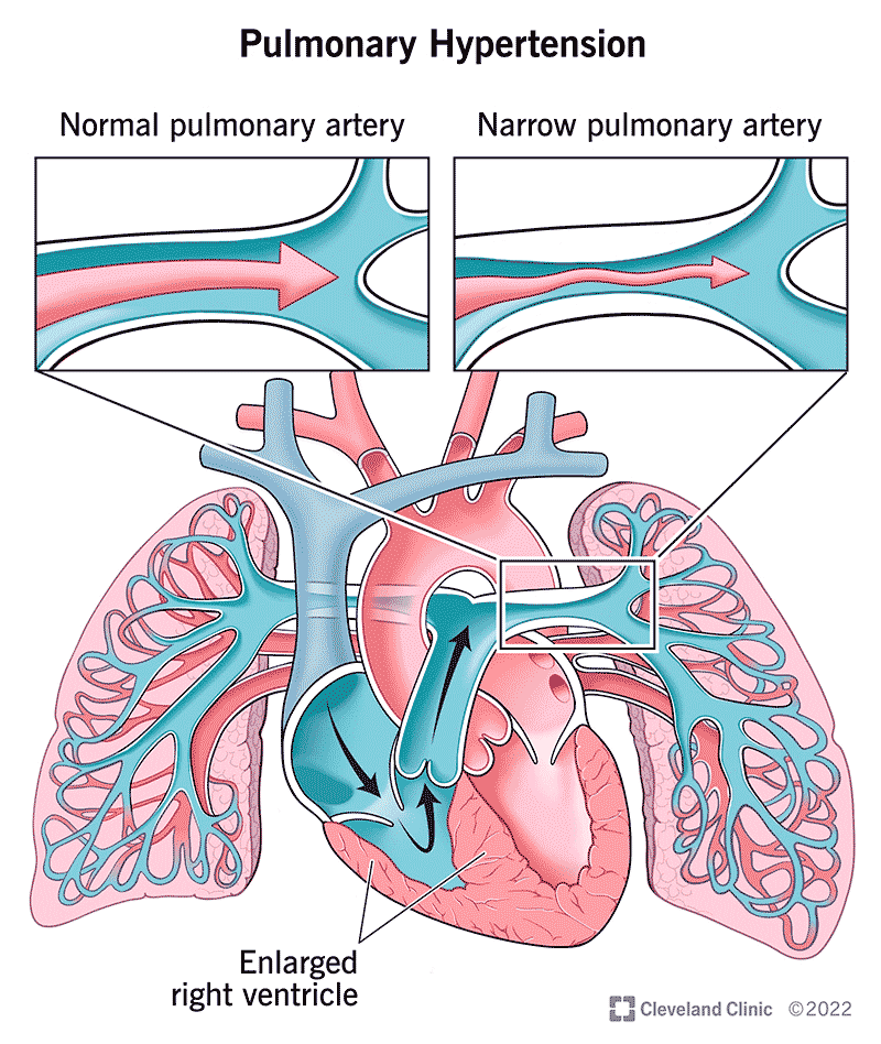 Portopulmonary Hypertension – What You Need to Know