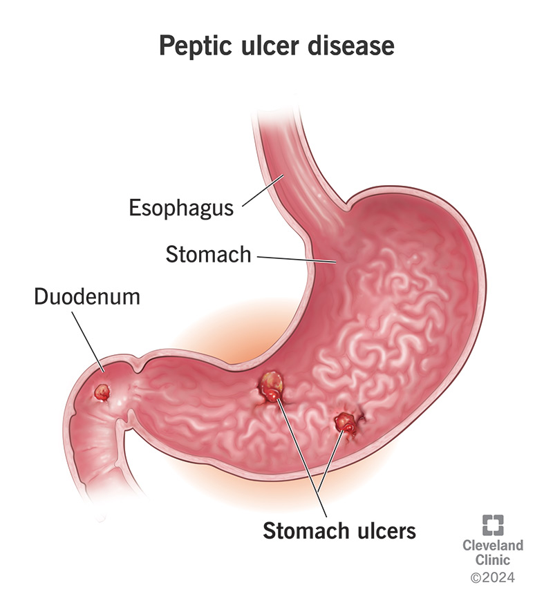 Prepyloric ulcer diagnosis: What to look for, test, and treat