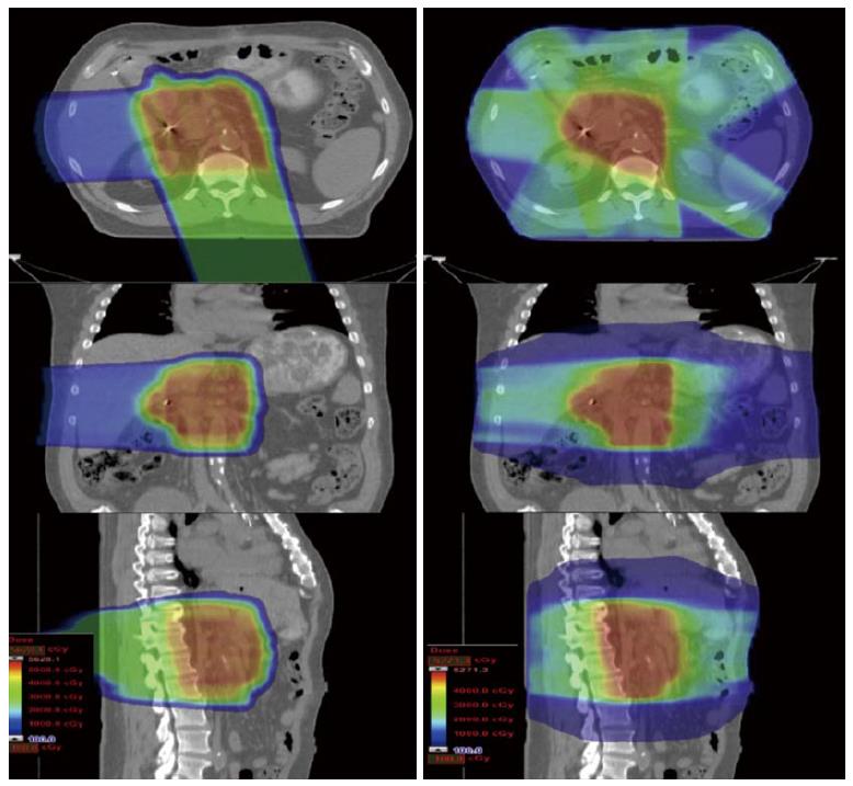 Proton Therapy for Pancreatic Cancer: Key Facts