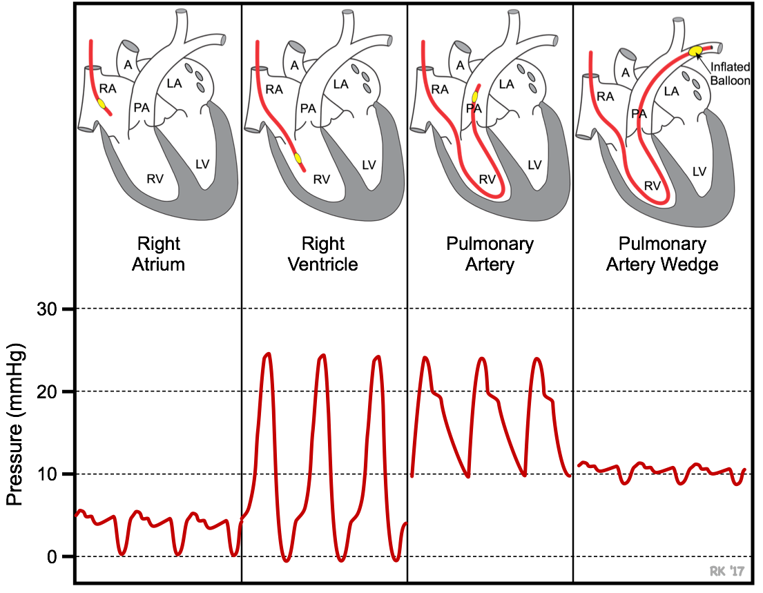 Pulmonary Artery Pressure: Quick Guide to What Matters