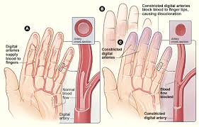 Raynaud Lupus Symptoms: What You Need to Know