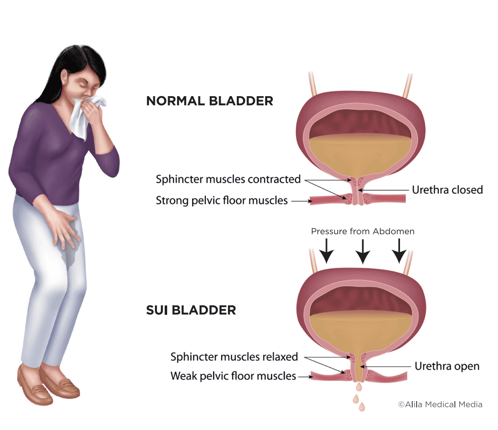 Understanding Stress Urinary Symptoms: Causes & Relief