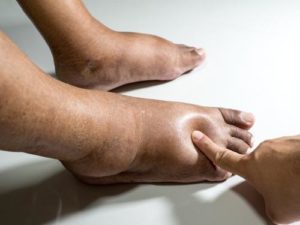 Swollen Legs in Elderly Female Treatment: Relief Tips