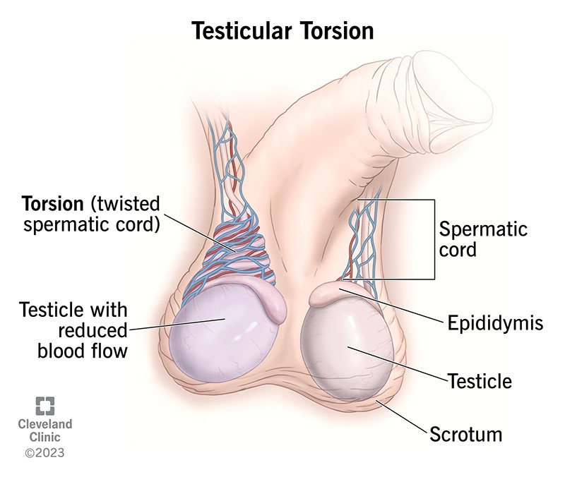 Testicular Torsion Symptoms: What You Need to Know Now