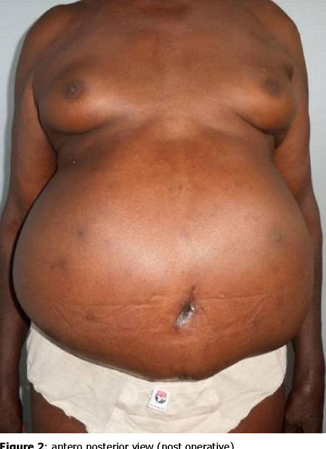 Truncal Obesity: Causes, Risks, and How to Treat It