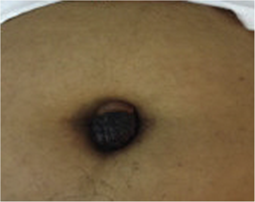 Umbilical Endometriosis Navel: Signs, Causes & Treatment