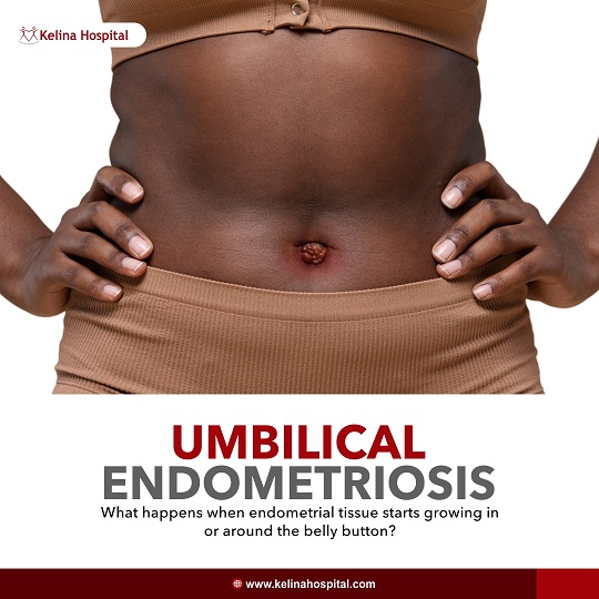 Umbilical Endometriosis Symptoms: Key Facts to Know