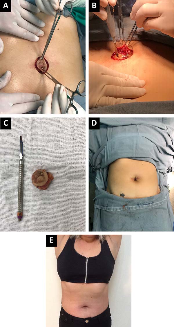 Umbilical Endometriosis Treatment: What Really Works?