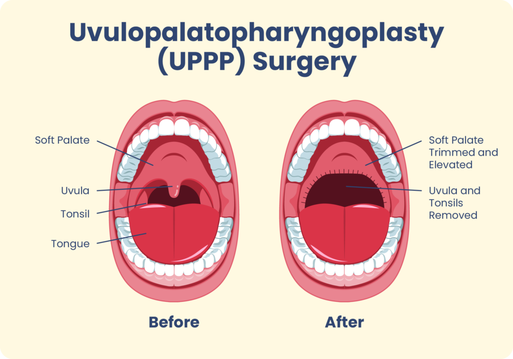UPPP Surgery Recovery Day by Day: What to Expect