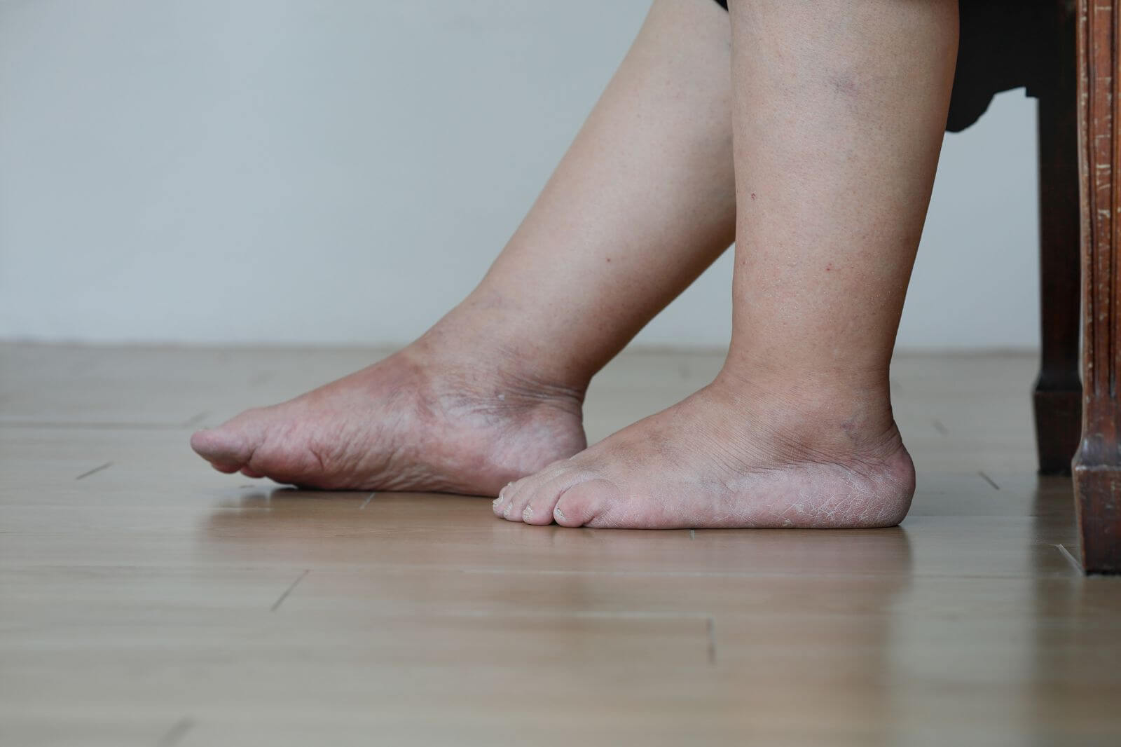 What Causes Swollen Legs From the Knee Down in Elderly