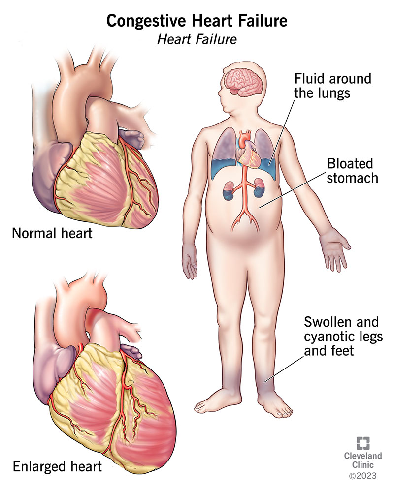 Is Sign of Worsening Heart Failure in Older Adults?