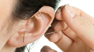 What Is the Success Rate of Acupuncture for Tinnitus?