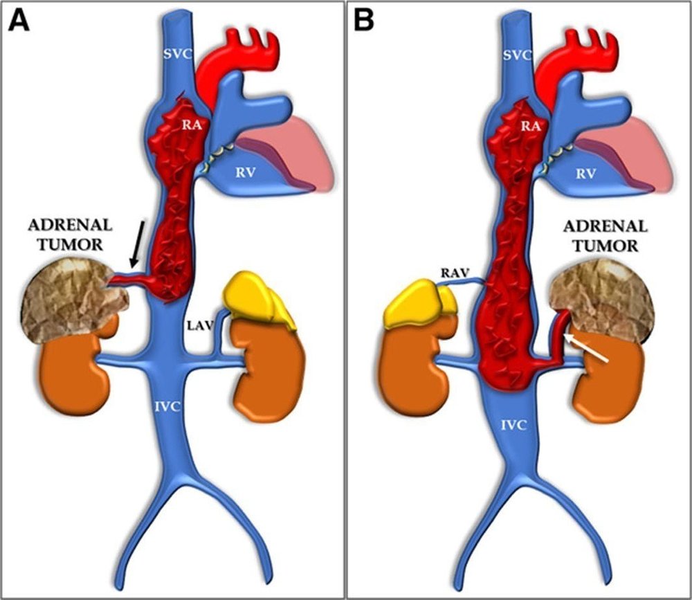 Adrenal Tumor Spread: What It Means & How to Manage It