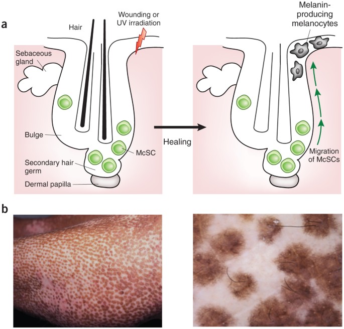 Melanocyte Destruction: What Really Happens in Vitiligo?