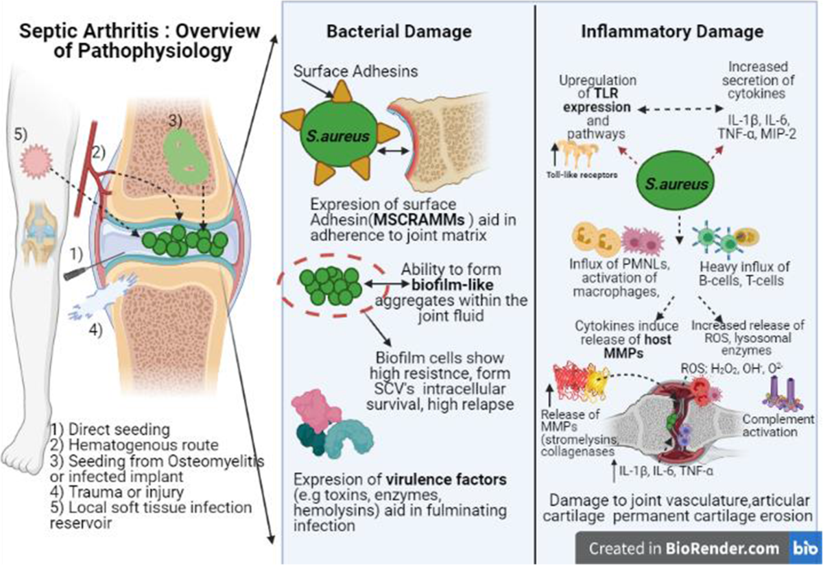 Septic Arthritis Prognosis: What You Need to Know