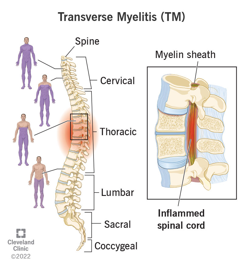 Spine Inflammation: Signs, Causes, and Treatment Guide
