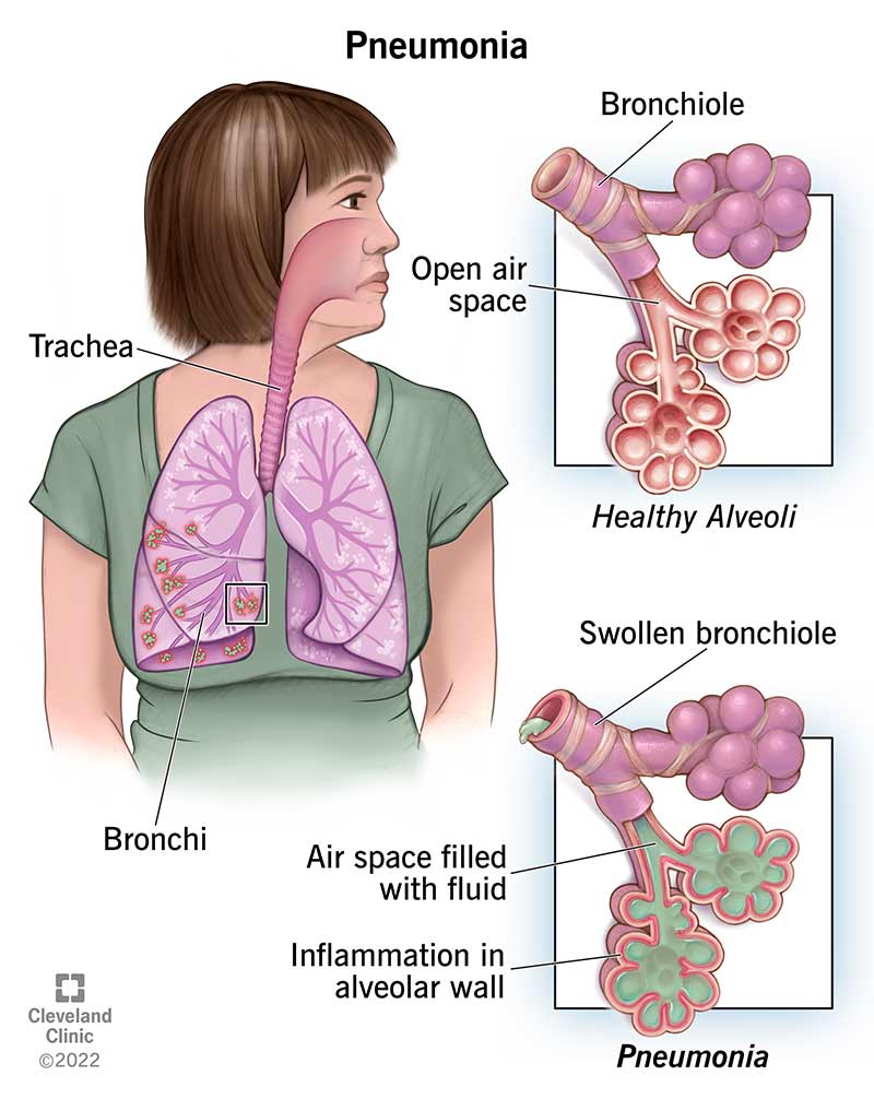 Ammonia Lung Symptoms: What to Spot & How to React