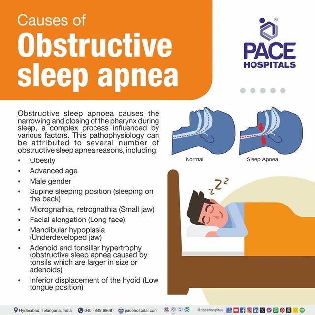 Apnea Causes: What Triggers Sleep Apnea for You?