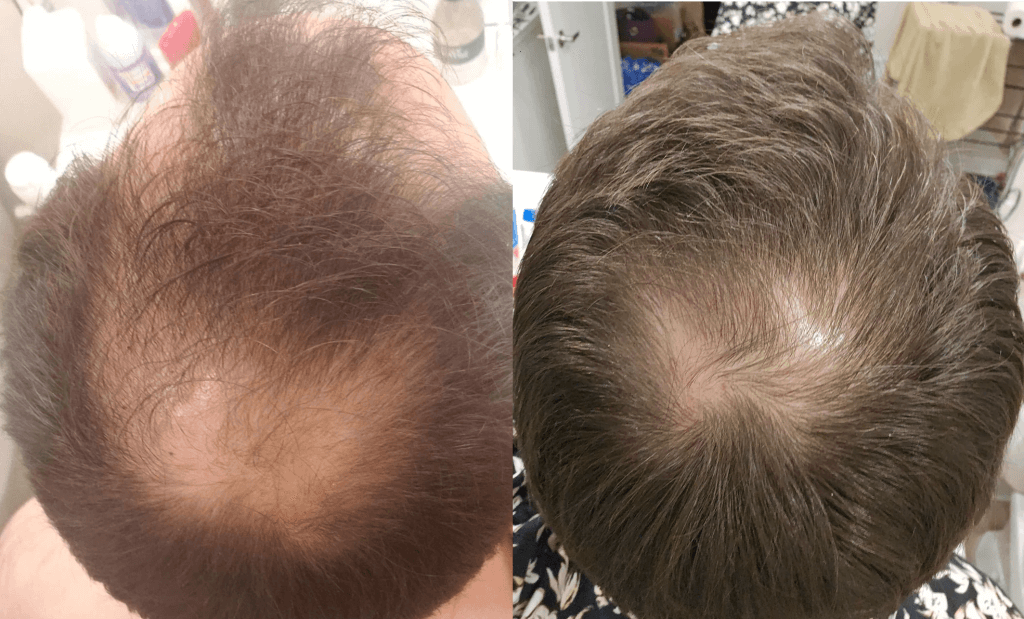 Does Rogaine Work? Real Results, Risks, and What Science Says