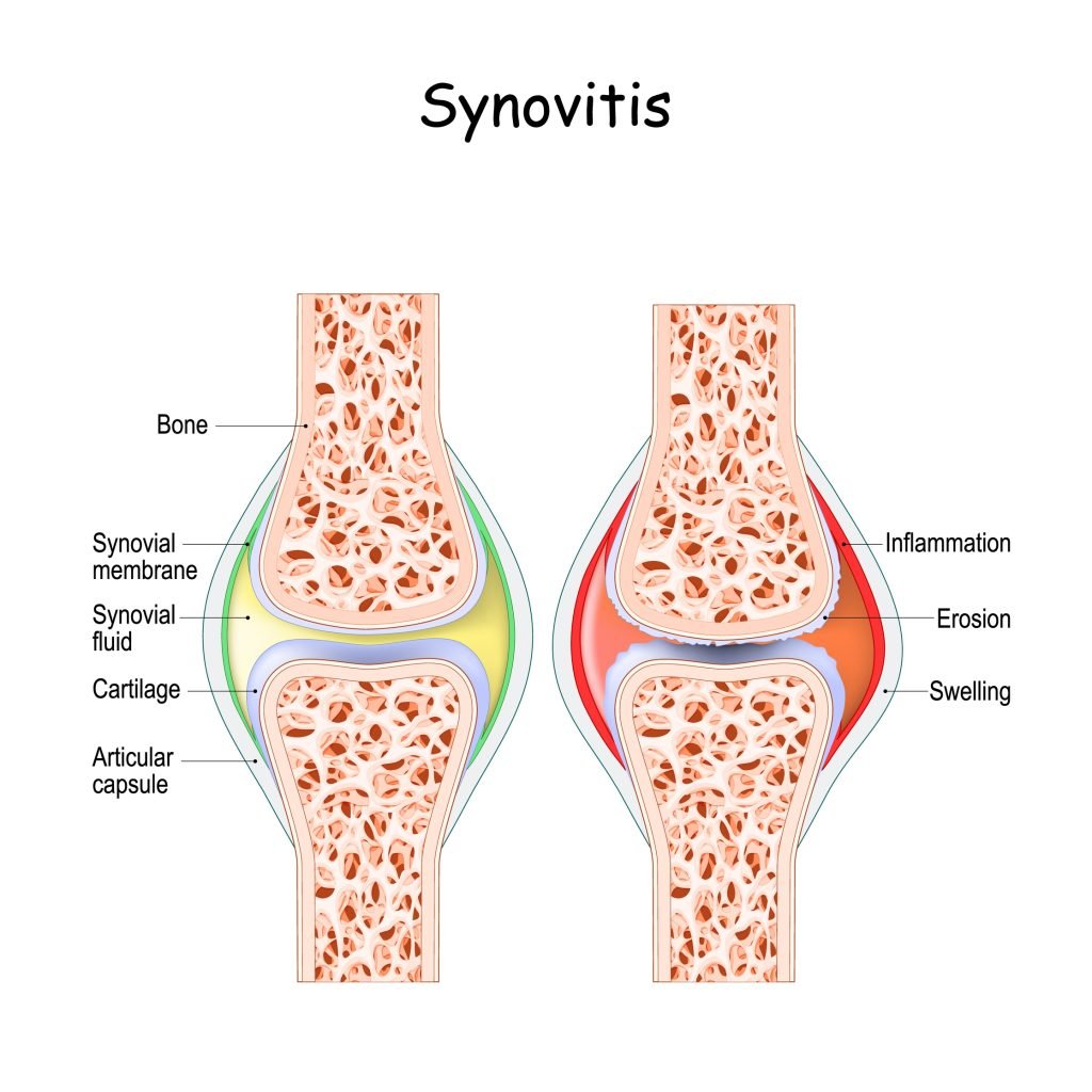 Transient Synovitis: Causes, Symptoms, Treatment & Care