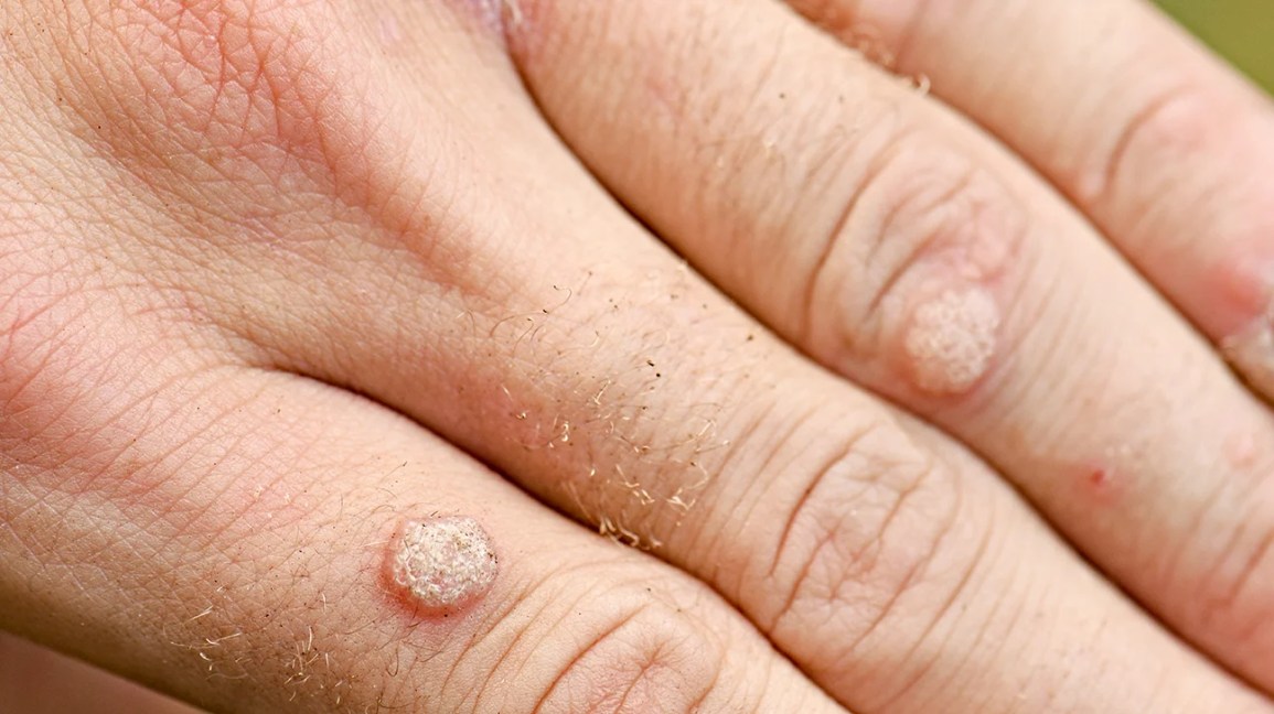 Understanding White Skin Bump: Causes, Care & Relief