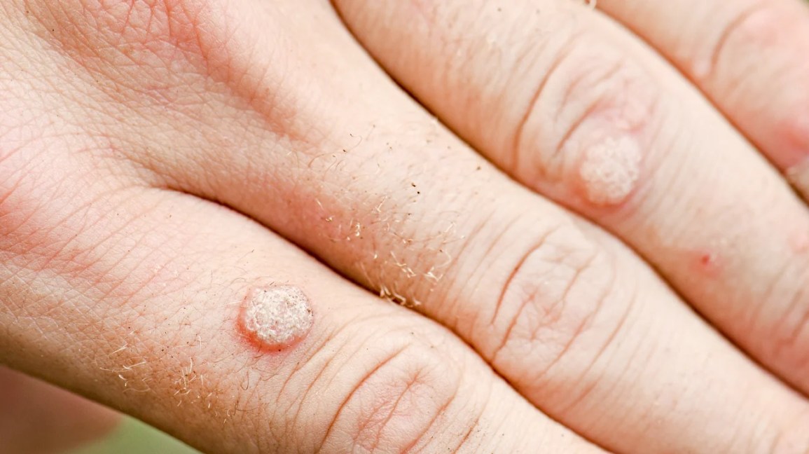 White skin lesion – causes, types & what to do