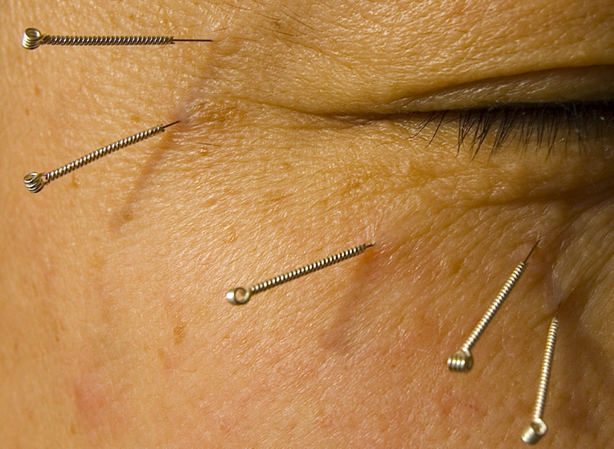 Acupuncture Eye Therapy: Surprising Benefits & Risks