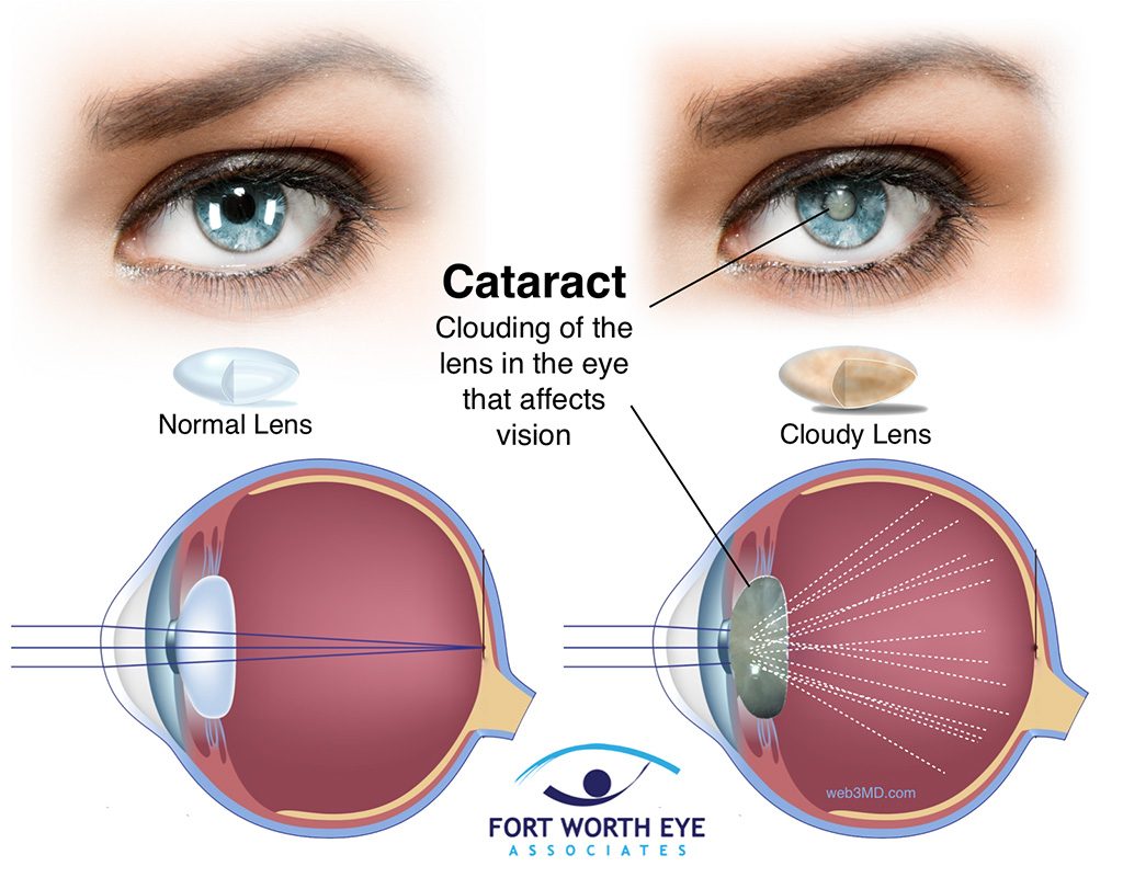 After Cataract Lenses: What to Expect & How to Thrive