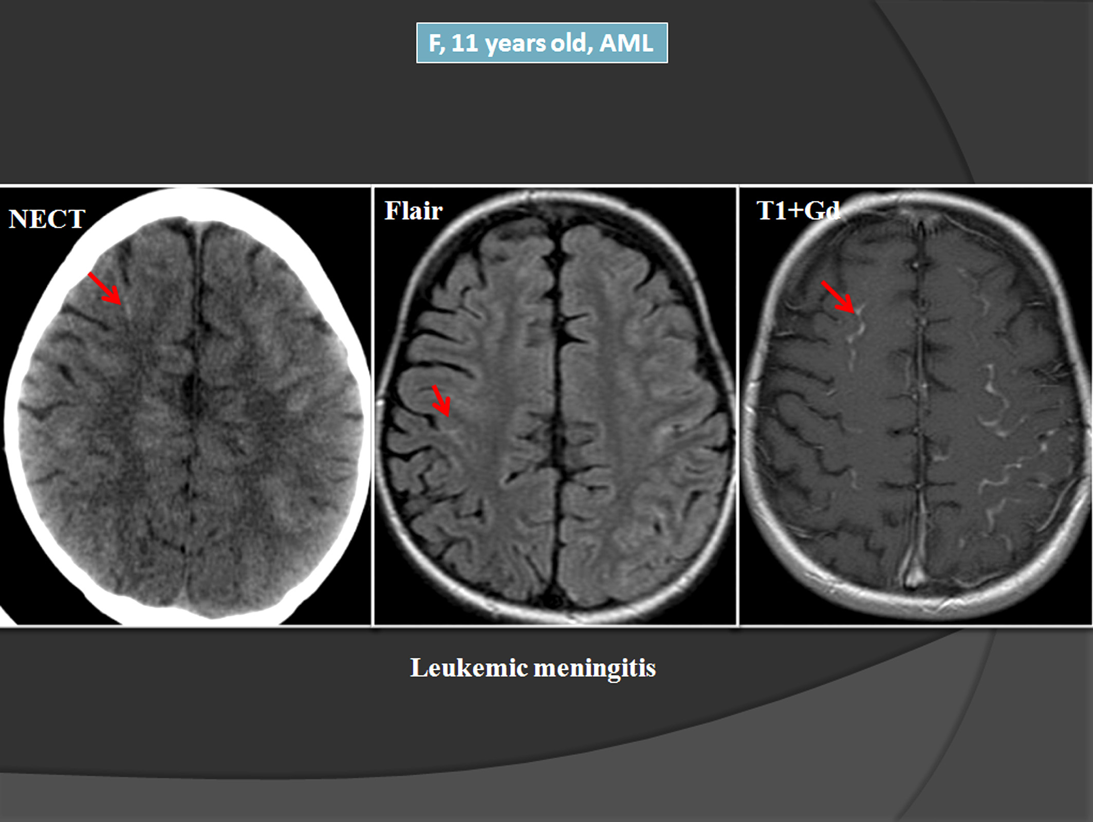 AML Meningitis: What It Is, Symptoms & Treatment