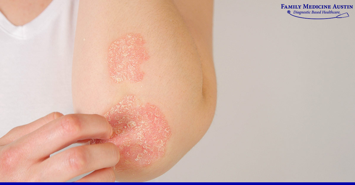 Autoimmune Skin Disorders: Symptoms, Types & Care