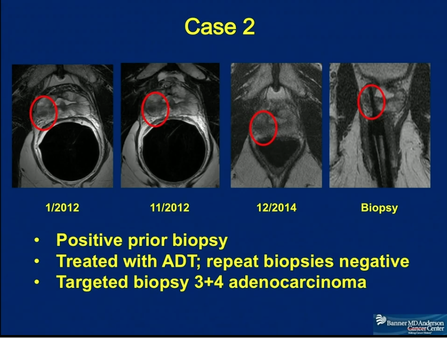 Biopsy vs MRI: Which Is Better for Prostate Cancer?